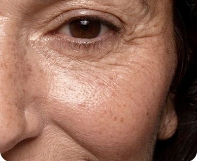 Aging/Pigmented Skin