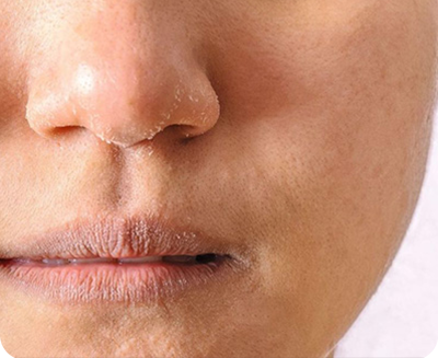 Anti Acne